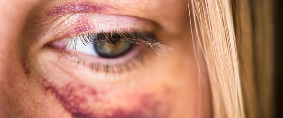 USA, New Jersey, Jersey City, Portrait of woman with black eye