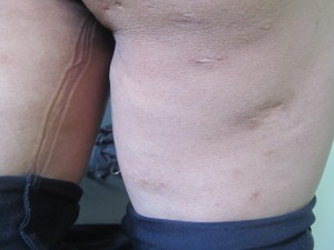 cicatriz-300x225