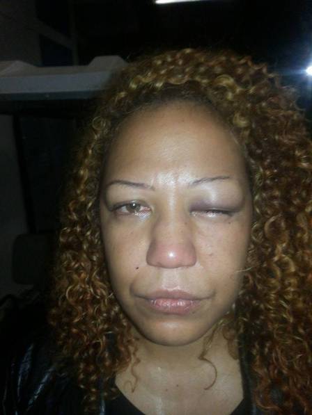 Cantora usa o Facebook para denunciar agressão do namorado