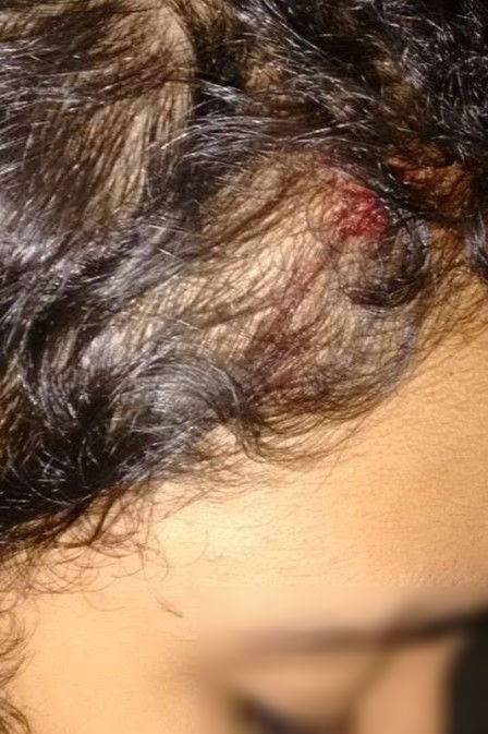 A garota, momentos após a pedrada Foto: Arquivo pessoal Leia mais: http://extra.globo.com/casos-de-policia/menina-vitima-de-pedrada-apos-sair-de-festa-do-candomble-alvo-de-ofensas-ao-ir-fazer-exame-de-corpo-de-delito-16468930.html#ixzz3dc4MuJ1G