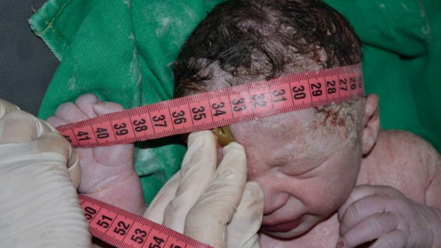 Além do perímetro cefálico ao nascer, médicos avaliam ritmo de crescimento da cabeça do bebê para confirmar ou descartar microcefalia
