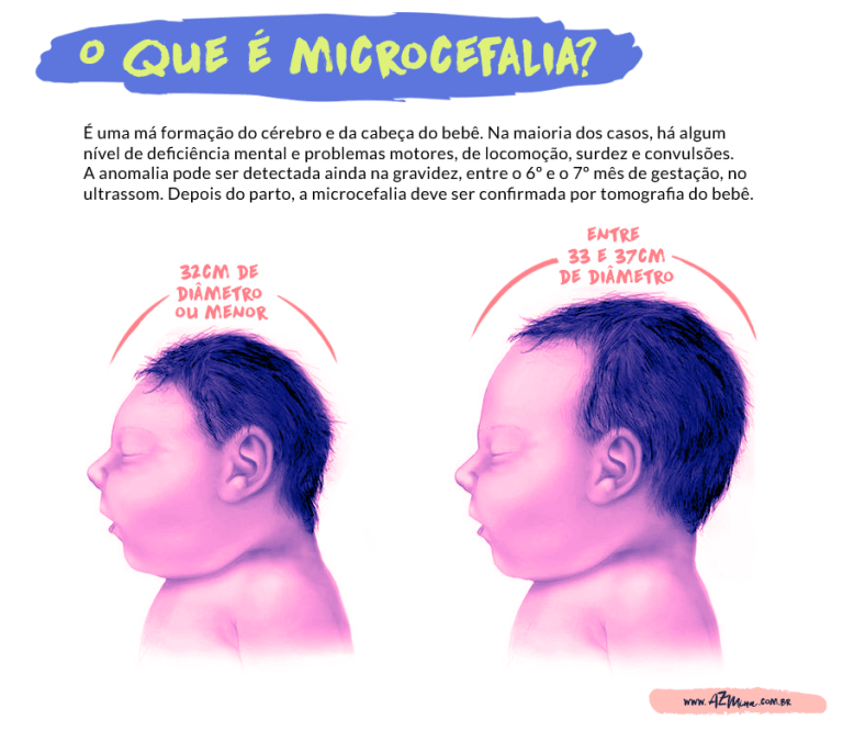 INFO_MICROCEFALIA