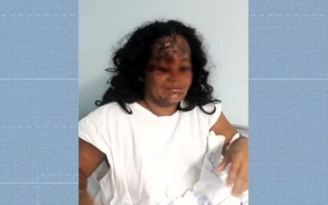 Mulher sofre queimaduras no rosto, após ex-marido não aceitar fim de relacionamento